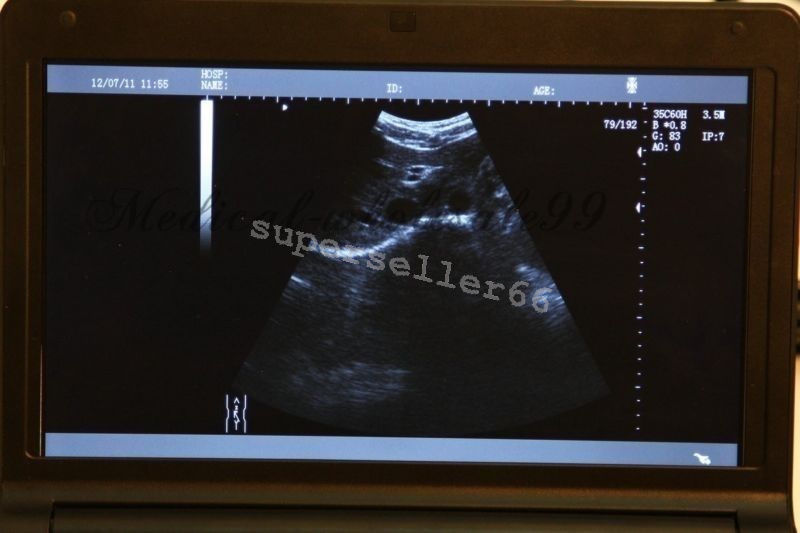 LCD Digital 10.1 Inch Ultrasound Scanner + Convex ,Transvaginal Probe ,Battery DIAGNOSTIC ULTRASOUND MACHINES FOR SALE