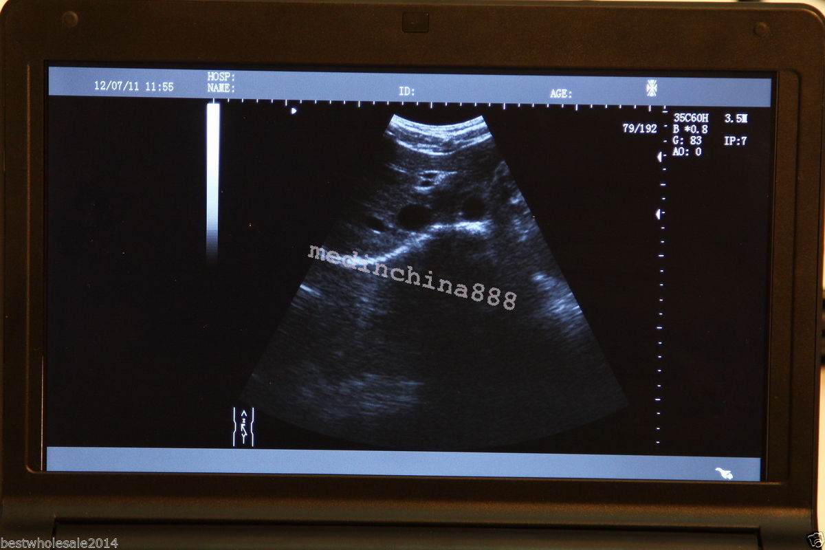 Portable LCD Digital 10.1-Inch Ultrasound Scanner + Convex+Transvaginal Probe CE DIAGNOSTIC ULTRASOUND MACHINES FOR SALE