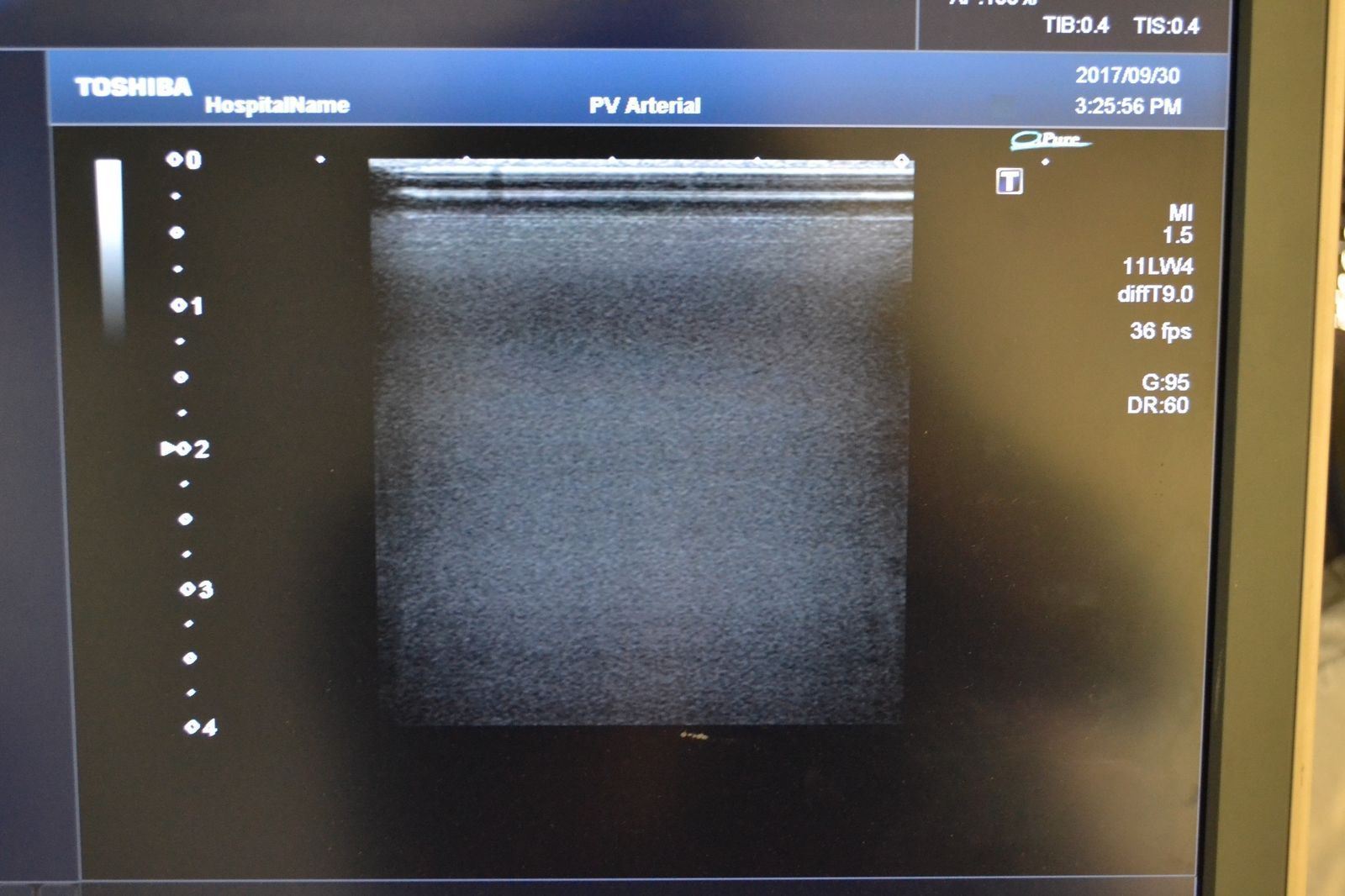 Toshiba Artida PLT-704SBT 11-4.8MHz Linear Ultrasound Transducer Probe J1625 DIAGNOSTIC ULTRASOUND MACHINES FOR SALE