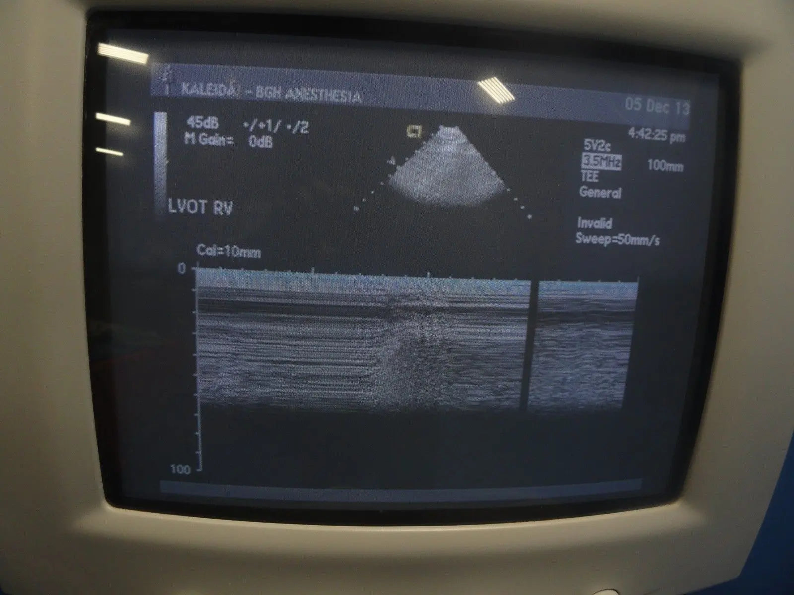 2002 Acuson Sequoia C256 Cardiac Ultrasound W/ 5V2C Probe Printer & VCR (6066) DIAGNOSTIC ULTRASOUND MACHINES FOR SALE