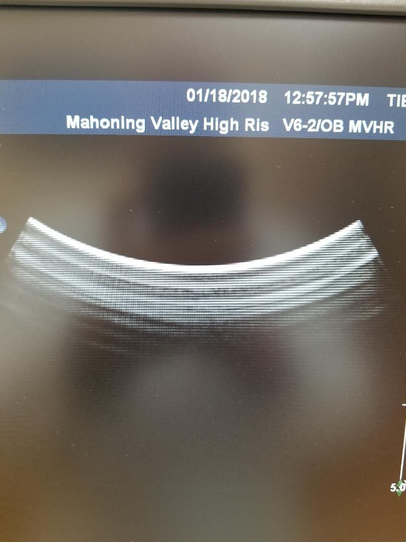 Philips iU22 F Cart Ultrasound System with 3 probe package, 3D/4D capability , DIAGNOSTIC ULTRASOUND MACHINES FOR SALE