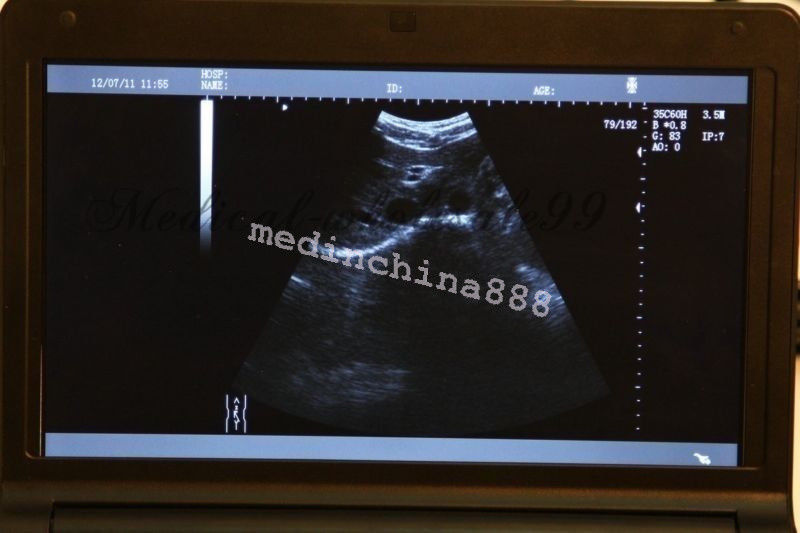 Laptop LCD Digital 10.1-Inch Ultrasound Scanner + Convex+Transvaginal Probe Care 190891247261 DIAGNOSTIC ULTRASOUND MACHINES FOR SALE