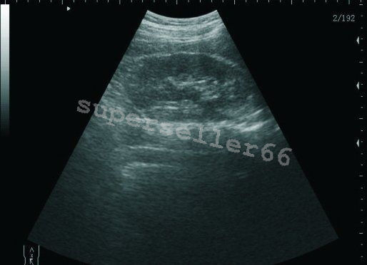 LCD Digital 10.1 Inch Ultrasound Scanner + Convex ,Transvaginal Probe ,Battery DIAGNOSTIC ULTRASOUND MACHINES FOR SALE